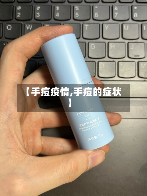 【手痘疫情,手痘的症状】-第1张图片